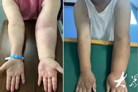 乳腺癌术后，别让上肢淋巴水肿来“敲门”！图片