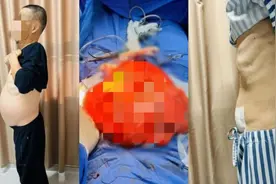 男子“啤酒肚”里竟藏着11公斤的肿瘤！医生提醒：腹部隆起恐是消化系统疾病图片