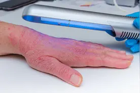 紫外线光疗不等于晒太阳，皮肤科专家：银屑病晒太阳，治疗作用有限图片