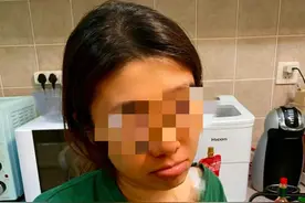 连吃三个月胡萝卜变成“小橘人”？专家提醒：这些食物吃多了也会变色图片