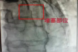 连续四晚玩手游至凌晨3点，长沙40岁男子突发心梗！专家：中青年发病率上升图片