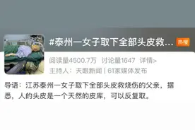 22岁女子取下全部头皮救父亲！她曾一头长发……图片