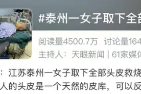 22岁女子取下全部头皮救父亲！她曾一头长发……图片