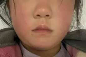 全身大面积红斑，竟然是高度传染性的它！图片
