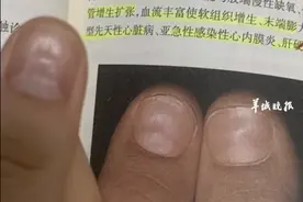 糟糕，我指甲上的“月牙”不见了，咋回事呀！图片
