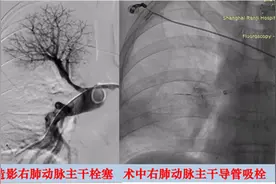 血栓，吸出来！仁济医院采用新一代微创器械挽救急性肺梗患者生命图片