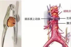 8岁孩子患“胡桃夹综合征”，医生叮嘱：多吃些长胖点！图片