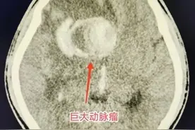 大脑10厘米深处有颗巨大动脉瘤！医生这样为小伙“拆弹”图片