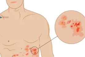 带状疱疹疼痛难忍，不如试试中医针灸治疗？图片