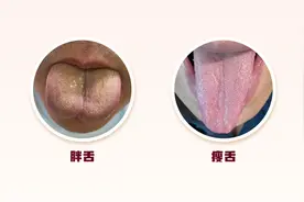 身体好不好，舌头先知道？舌头这些变化，可能与肌瘤、肿瘤相关！自查图片