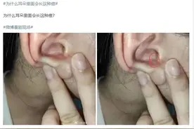 耳朵长痘，一碰就痛！宁波小伙慌了，已经影响听力！医生：千万别这么做……图片