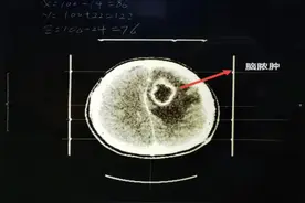 挤痘痘竟致脑脓肿，手术抽出脓液10多毫升！医生：面部危险三角区碰不得图片