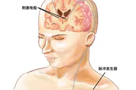国内首例！上海医生为癫痫患者植入具感知功能的“脑起搏器”图片