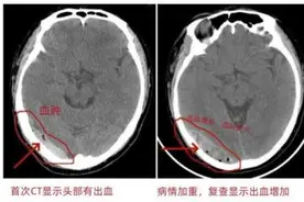 长沙男子骑车摔伤后轻微头晕自觉“无碍”，差点丢了命图片