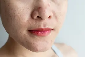 可以“插秧”的毛孔，我该怎么拯救你？图片