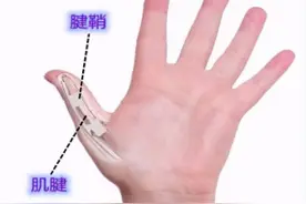腱鞘炎，轻轻一勾，手指灵活了！图片