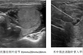 甲状腺大结节不用“切”？  一“针”解决不留疤痕图片