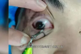 看着就疼！男子被鱼钩勾住眼球图片