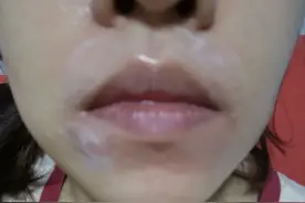 使用脱毛膏导致烧伤！专家：敏感部位更易引起不良反应图片