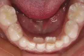 双排牙怎么办？图片