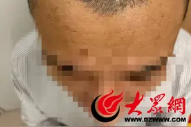 菏泽市中医医院大学路院区皮肤科完成“微创式”自体毛发移植术图片