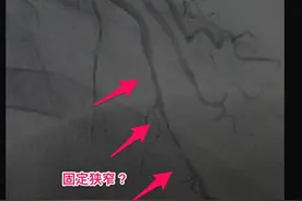女子胸痛半年终寻“元凶”，原是心脏血管“抽筋”了图片