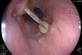 一次性塑料碗碎片在食管里待了3个月，女子食管溃烂接受手术图片
