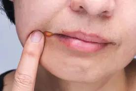 嘴上起水泡不是上火！小心是这种终身潜伏的病毒→图片