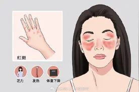 红斑狼疮的症状有哪些？图片
