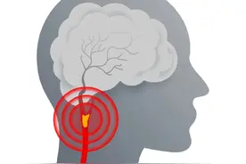 警惕，这个颈动脉里的“定时炸弹”可能正在袭击你！建议定期做这项检查→图片