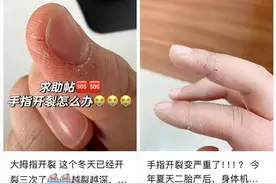 一到冬天手指为啥就开裂脱皮？专家建议抓住“黄金三分钟”图片
