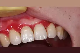 一种让牙齿容易脱落的病 很多人年轻时不重视图片