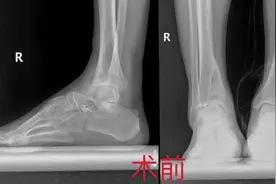 重医二院·医界绝技｜强“关”劲“节”⑤ 60岁患者踝关节疼痛不能行走，关节置换术后重获正常生活图片