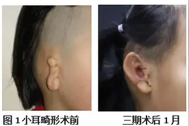 这一治疗术，帮助孩子们拥有“新”耳朵图片