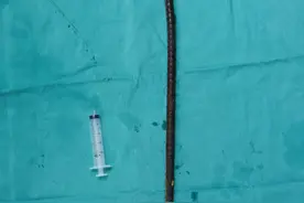 男子被1米长钢筋贯穿身体：下腹穿入锁骨穿出，6小时手术生死营救图片