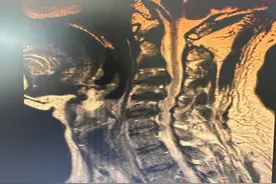 一个“钥匙孔”，就能治好颈椎病图片