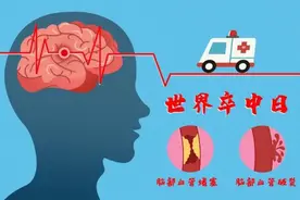 杭州小伙30岁出头，居然中风了！自以为酒喝多了走不稳……医生：这些症状千万当心图片