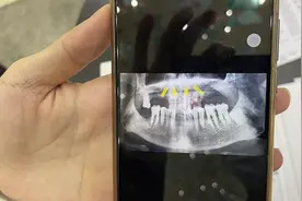 爹爹花3万元种牙，“好牙”却被拔掉，华美整形医院称获患者同意，患者表示信息被动手脚图片
