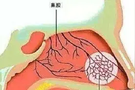 秋冬季节，鼻腔干燥怎么办？图片