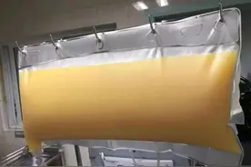 男子血液像牛奶，从中分离出近2升油浆！这些习惯很多人都有图片