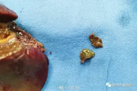 27岁女子生吃荸荠体内取出2条虫图片