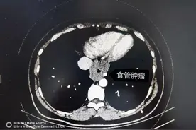 石家庄女子吃饭时觉得噎得慌，一查竟然得了肿瘤！提醒，这些坏习惯一定要改......图片