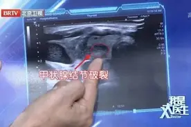 2年没复查，息肉变成癌！B超报告里出现“这些字眼”可能就危险了，别等严重时才后悔图片