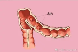 体检查出结肠息肉一定需要治疗吗？图片