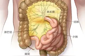 【儿研所儿医说】肠系膜淋巴结炎图片