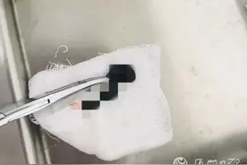 男子流鼻血一周，竟从鼻腔取出一条虫！活的图片