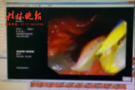 广西女子肝脏被吃掉三分之一！找到“凶手”，医生连呼太罕见图片