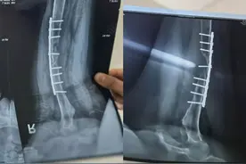 拯救消失的骨头：罕见病女孩求医广州119小时终确诊，“我第一次看到爸爸哭”图片