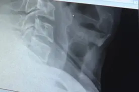 男子喝听装啤酒，居然连拉环也吞下去了......差点窒息图片