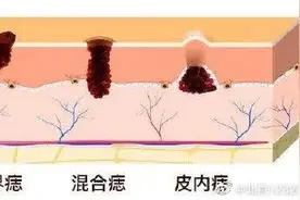 这4种痣恶变风险高 建议切除图片